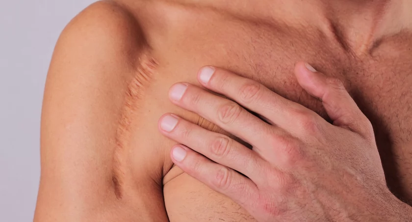 Niektóre dysfunkcje czy ból – niekoniecznie w okolicy blizny – mogą być powodowane samą blizną, ale odpowiednio dobrana terapia oraz zaangażowanie pacjenta w leczenie przyczyniają się do znaczącej poprawy jakości życia.